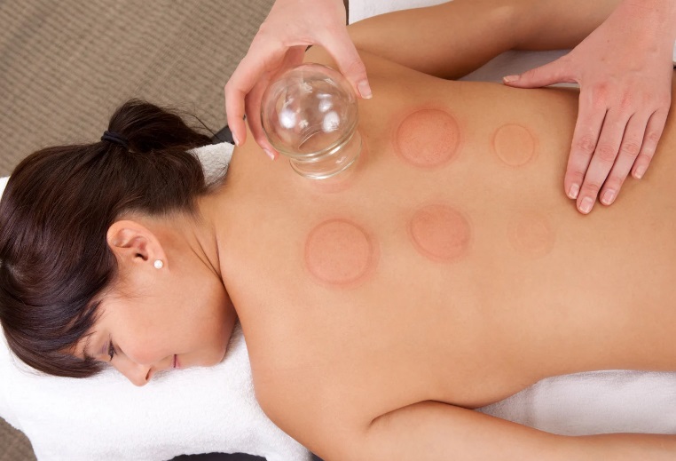 Best Cupping therapy treatment near me in Stirling